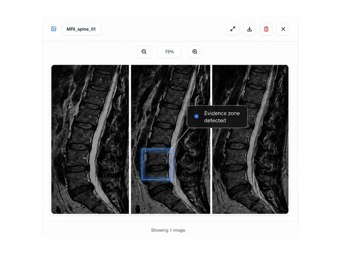 Avicen radiography viewer highlighting evidence on a medical image
