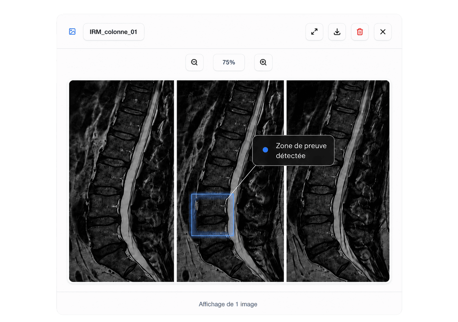 Visionneuse de radiographie Avicen : mise en évidence des preuves directement sur une image médicale avec annotations sourcées